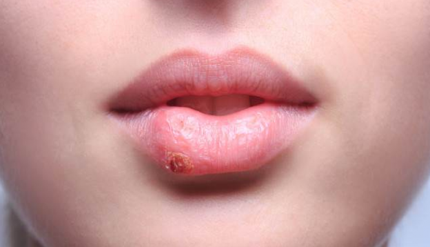 Herpes labial